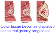 Colon tissue becomes displaced as the malignancy progresses.