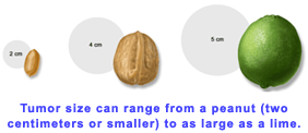 Tumor size can range from a peanut (two centimeters or smaller) to as large as a lime.