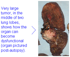 Very large tumor, in the middle of two lung lobes, shows how the organ can become dysfunctional.